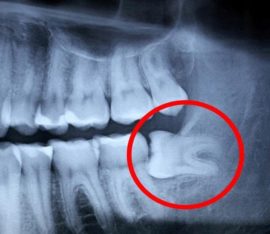 Răng X-quang trí tuệ