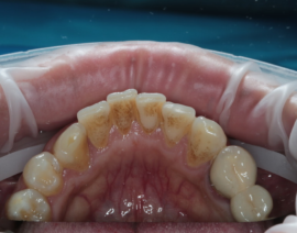 Zahnstein auf den Zähnen