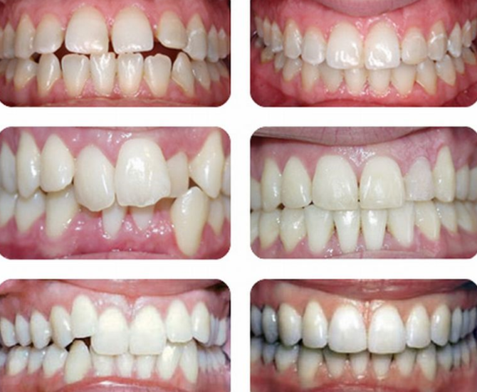 Teeth of children before and after insertion of plates
