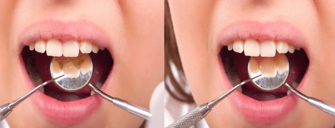 Gigi sebelum dan selepas skala
