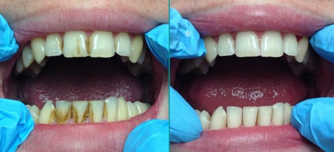 Zuby pred a po čistení zubov